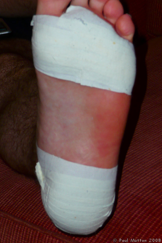 P1000276 Bandaged Foot